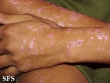 lichen planus actinicus