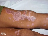 lichen planus actinicus