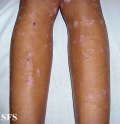 lichen planus actinicus