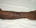 lichen planus actinicus
