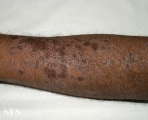 lichen planus actinicus