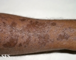 lichen planus actinicus