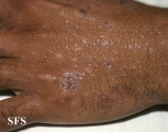 lichen planus actinicus