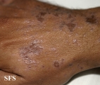 lichen planus actinicus