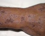 lichen planus actinicus