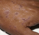 lichen planus actinicus