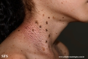 dyskeratosis_congenita