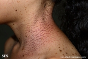 dyskeratosis_congenita
