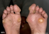 palmoplantar_keratoderma-focal_keratoderma