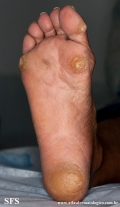 palmoplantar_keratoderma-focal_keratoderma