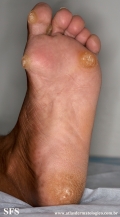 palmoplantar_keratoderma-focal_keratoderma