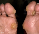 palmoplantar_keratoderma-focal_keratoderma