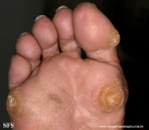 palmoplantar_keratoderma-focal_keratoderma