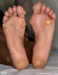 palmoplantar_keratoderma-focal_keratoderma