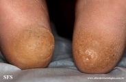 palmoplantar_keratoderma-focal_keratoderma