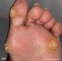 palmoplantar_keratoderma-focal_keratoderma