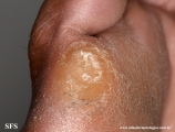 palmoplantar_keratoderma-focal_keratoderma
