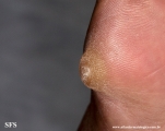palmoplantar_keratoderma-focal_keratoderma