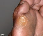 palmoplantar_keratoderma-focal_keratoderma
