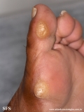 palmoplantar_keratoderma-focal_keratoderma
