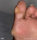 palmoplantar_keratoderma-focal_keratoderma