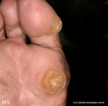 palmoplantar_keratoderma-focal_keratoderma