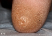 palmoplantar_keratoderma-focal_keratoderma