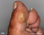 palmoplantar_keratoderma-focal_keratoderma