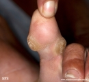 palmoplantar_keratoderma-focal_keratoderma