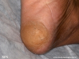 palmoplantar_keratoderma-focal_keratoderma