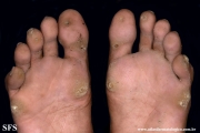 palmoplantar_keratoderma-focal_keratoderma