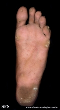 palmoplantar_keratoderma-focal_keratoderma