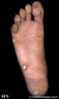 palmoplantar_keratoderma-focal_keratoderma