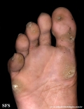 palmoplantar_keratoderma-focal_keratoderma