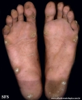 palmoplantar_keratoderma-focal_keratoderma