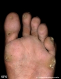 palmoplantar_keratoderma-focal_keratoderma