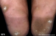 palmoplantar_keratoderma-focal_keratoderma