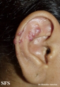 angiolymphoid hyperplasia with eosinophilia