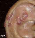 angiolymphoid hyperplasia with eosinophilia