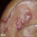angiolymphoid hyperplasia with eosinophilia