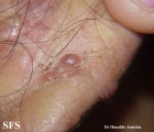 angiolymphoid hyperplasia with eosinophilia