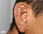 angiolymphoid hyperplasia with eosinophilia