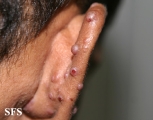 angiolymphoid hyperplasia with eosinophilia