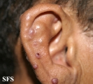 angiolymphoid hyperplasia with eosinophilia
