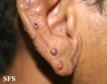 angiolymphoid hyperplasia with eosinophilia