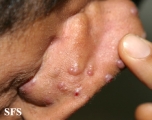 angiolymphoid hyperplasia with eosinophilia