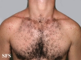 malassezia folliculitis