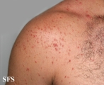 malassezia folliculitis