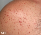 malassezia folliculitis