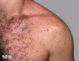 malassezia folliculitis